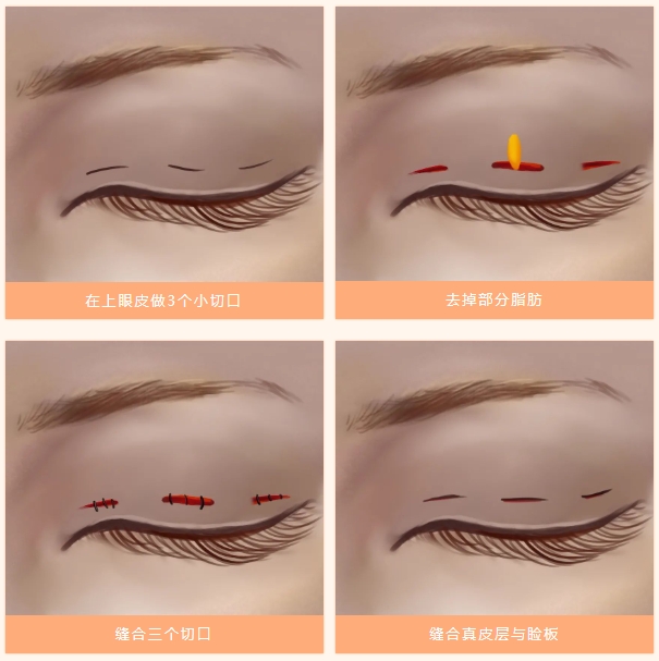 雙眼皮