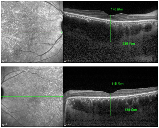 視網(wǎng)膜病變